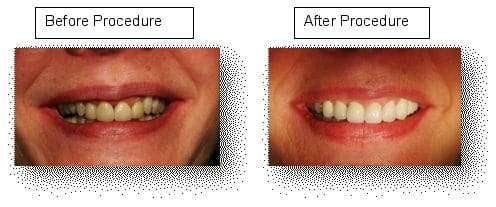 Reconstruction with a Quadrant of Crowns Seated on Implants