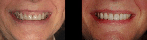 Before and after: Correcting a Gummy Smile