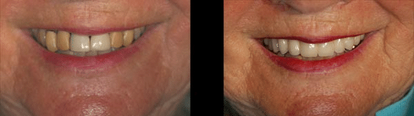 Before and after: The Compromised Smile