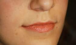 Patient final result showing restored smile with dental implants at age 21