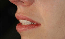 Clinical detail of dramatic smile improvement case