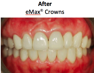 Close-up view of crown translucency comparison