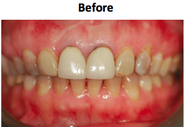 Detailed view of porcelain crown esthetics