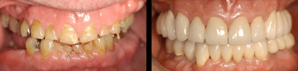 Before and after: Dental Implant Rejuvenation of the Jaw