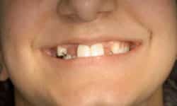 Front view of initial smile showing missing teeth and collapsed profile