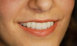 Beautiful final smile after completing comprehensive implant restoration