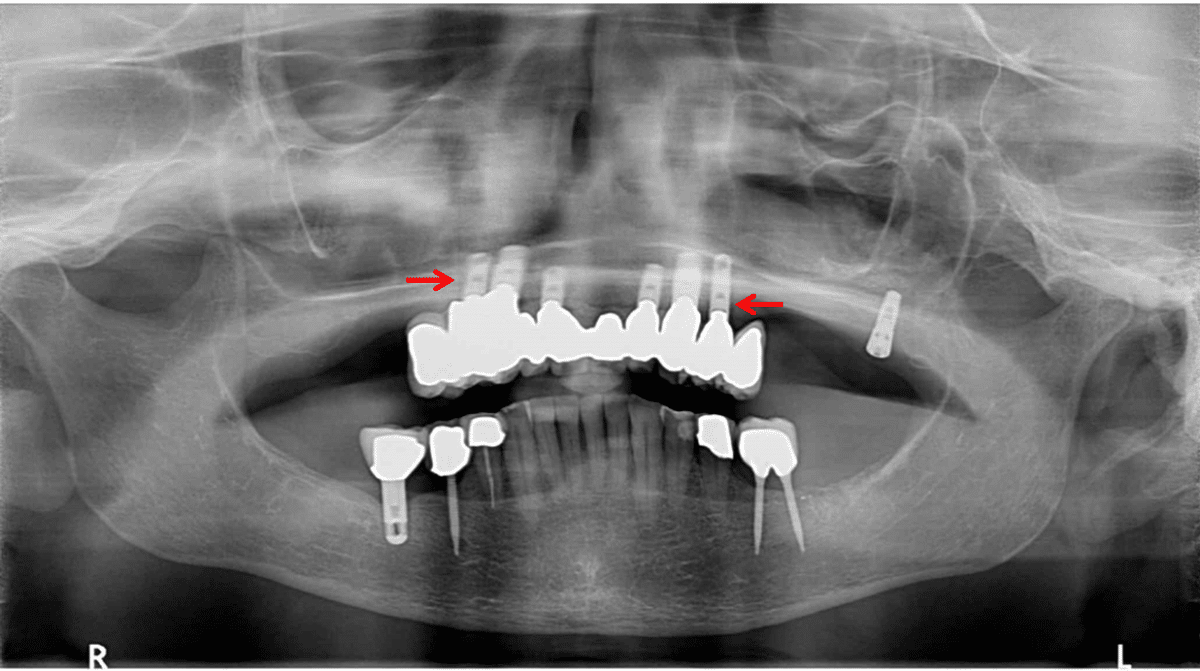 Before and after: Implant Supported Reconstruction