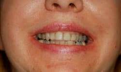 Before and after: An Esthetic Correction