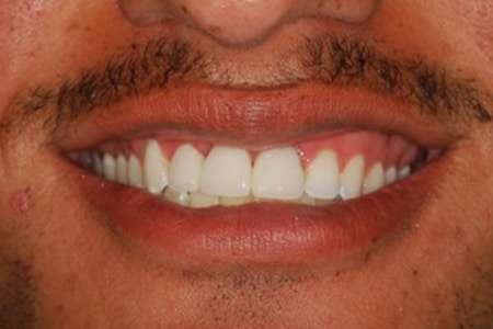 Final smile line after custom crown placement
