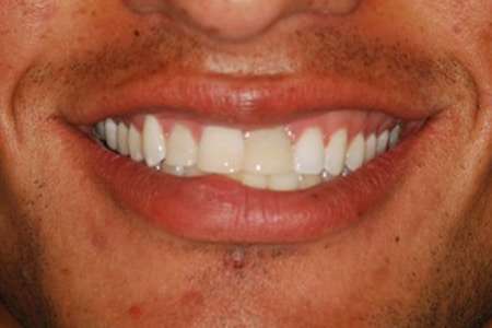 Initial smile line showing damaged front teeth