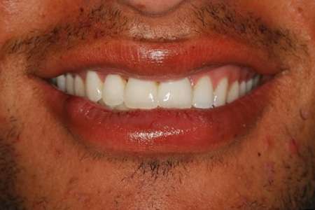 Temporary crowns during treatment phase