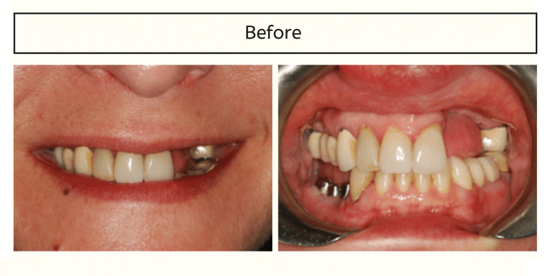 Before: Smile Makeover with Dentition Reconstruction