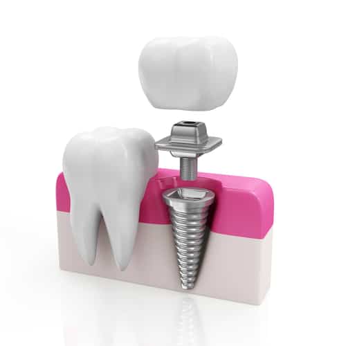 Dental Implants High Tech Teeth