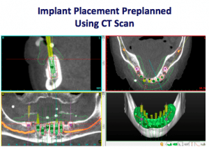 Implant Placement Preplanned Using Ct Scan 1