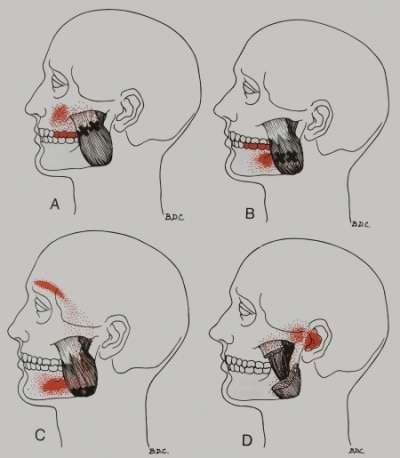 Masseter Muscle 2 0