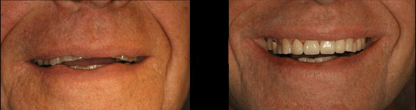 Before: Repairing the Worn Out Dentition