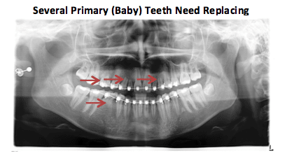 After: Dental Implants for a Dramatic Cosmetic Smile Makeover