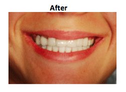 Dental implant placement clinical view