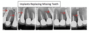 Final implant-supported smile makeover result