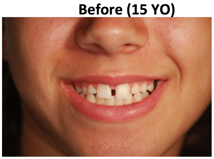 Before treatment showing compromised dental condition