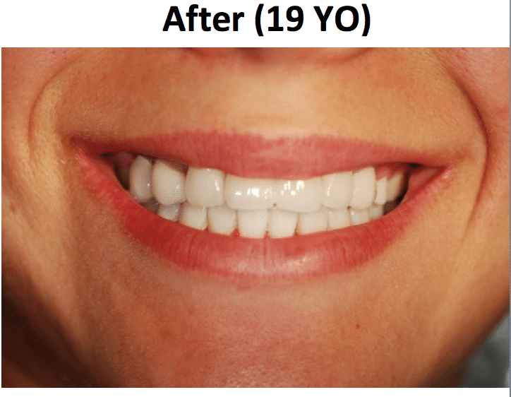 Dental implant cosmetic restoration clinical photo