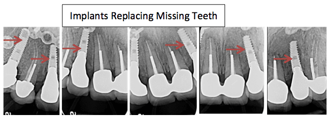 Smile makeover progress view showing implant integration