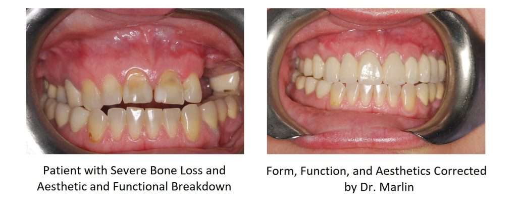Bone Loss Before And After