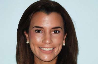 Patient full face after cosmetic smile restoration showing natural appearance