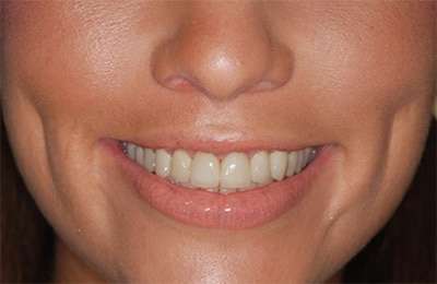 Rejuvenated smile with natural-looking custom dental crowns after restoration