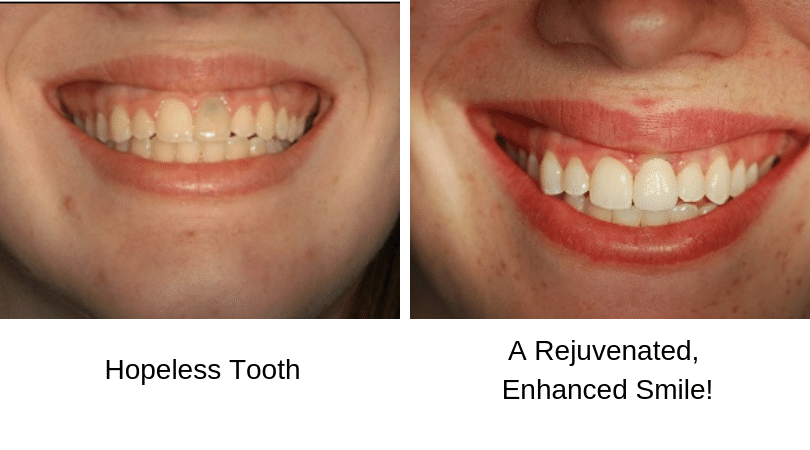 Front Tooth Before After