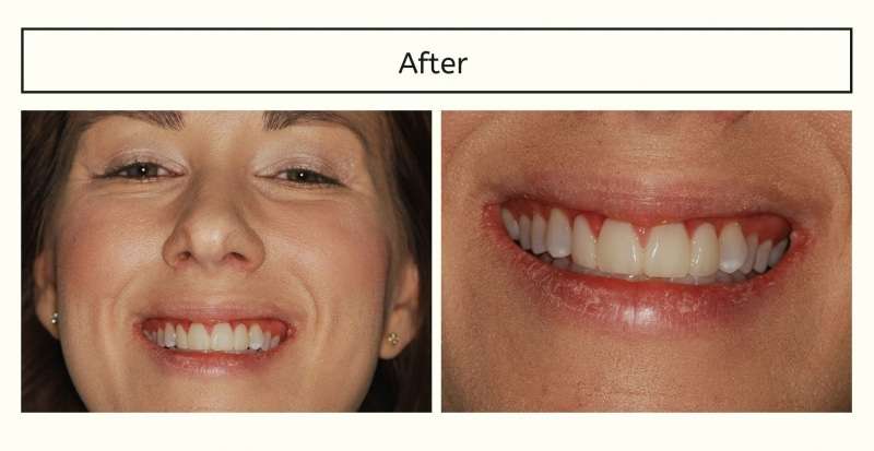 After: The Immediate Gummy Smile Makeover