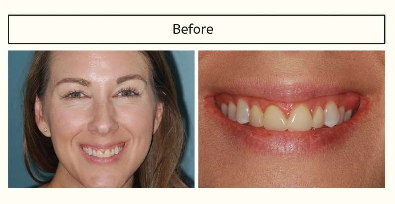 Before: The Immediate Gummy Smile Makeover