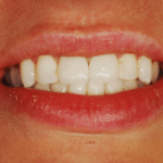 After: Emergency Repair of Two Fractured Front Teeth