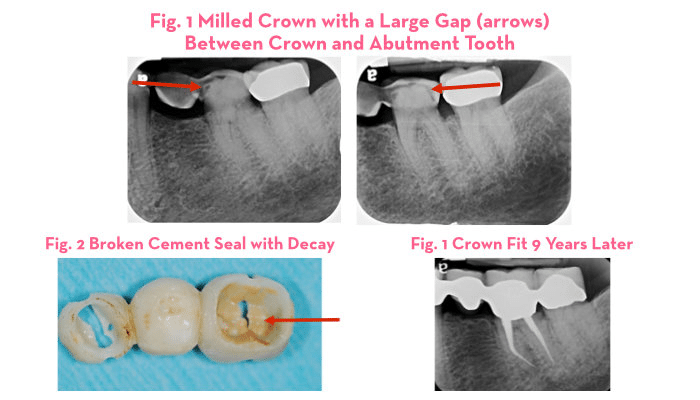 Milled bridge showing gap between tooth preparation and crown