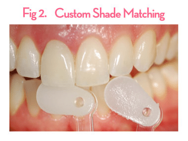 Commercial laboratory crown appearance example