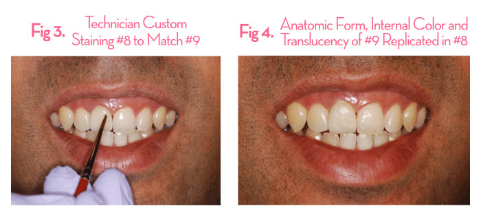 In-house lab shade matching and crown development process