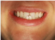 Broken front teeth before crown restoration
