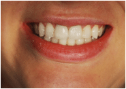 Restored front teeth with natural-looking crowns