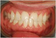 Severely damaged front tooth before restoration