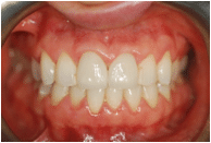 Restored tooth with seamless crown restoration