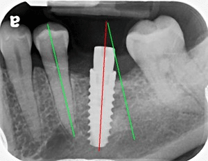 Before: Poor Implant Placement Causes Its Failure