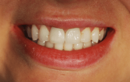 Emergency repair of fractured anterior teeth clinical result