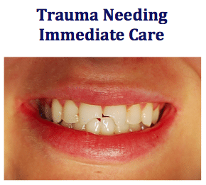 Before: Rapid Repair of Two Fractured Anterior Teeth