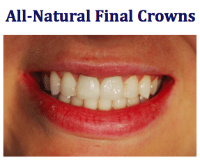 Fractured anterior teeth emergency repair case