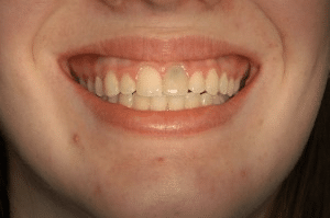 Initial presentation showing failing maxillary central incisor