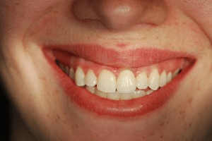 CT scan surgical guide for precision implant placement