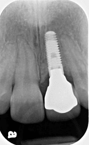 Final result showing rejuvenated dentition with natural-looking implant crown