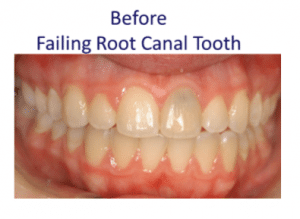 Examples of porcelain crowns fabricated on metal coping