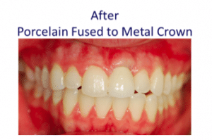 Metal and porcelain crown cross-section