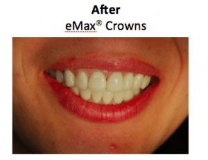 Zirconia coping and crown components